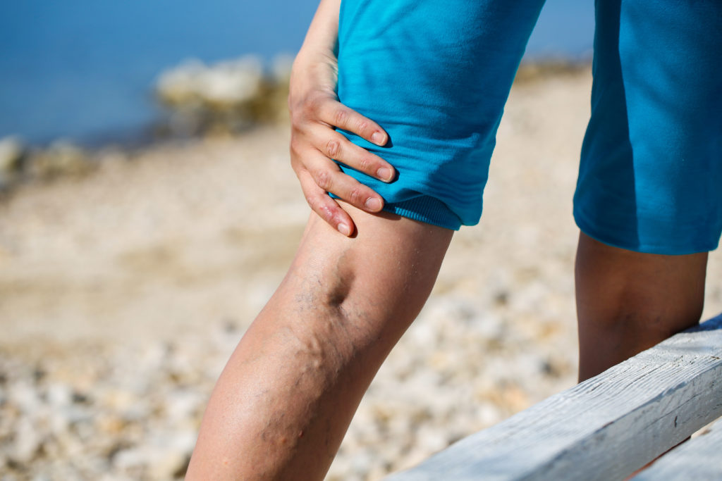 painful varicose veins in need of varicose veins treatment