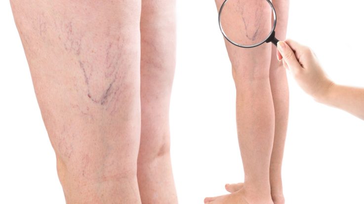 How Can I Get My Varicose Veins Removed?