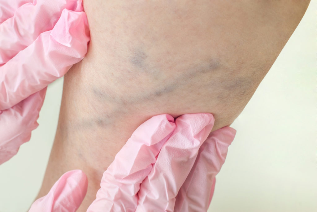 Examination of varicose veins on the womans legs