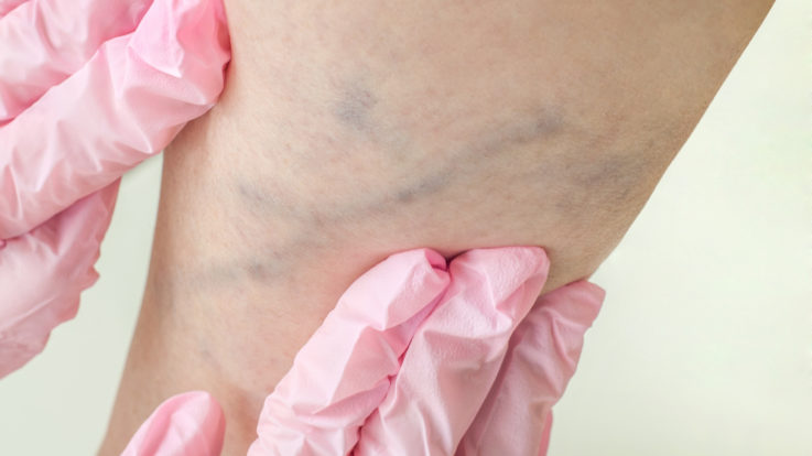 You’ve Got Vein Treatment Options!