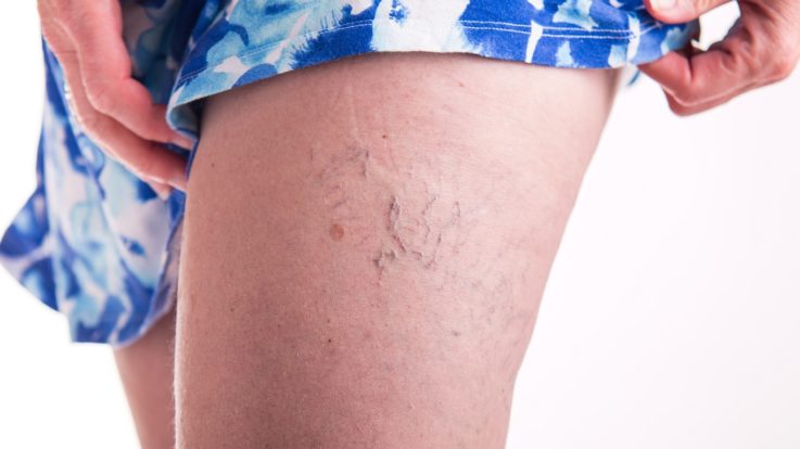 Spider Vein Treatment