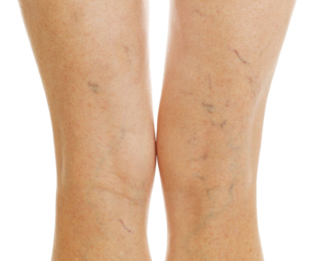 vein treatment