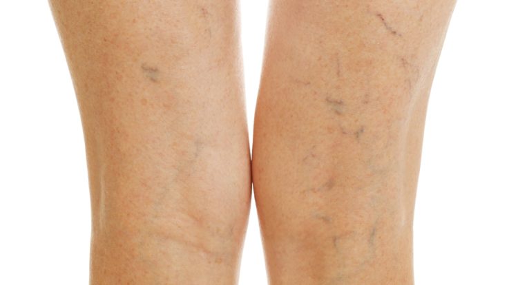 The Types of Vein Treatment We Offer at El Paso Varicose Vein Laser Clinic