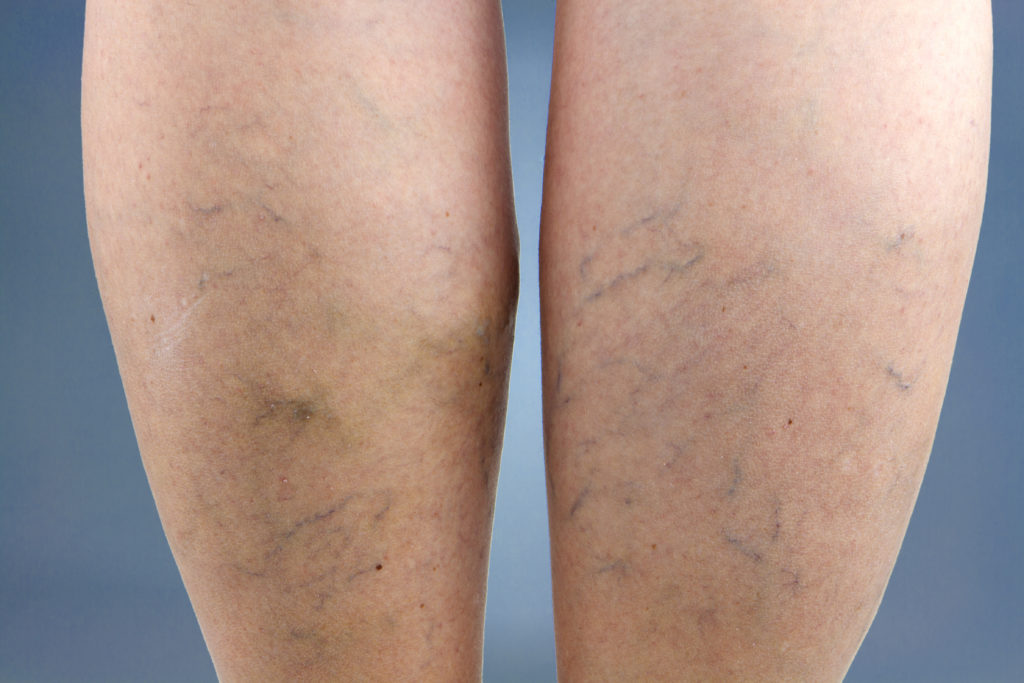 varicose veins