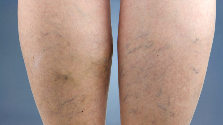 I Have Varicose Veins: What Are My Treatment Options?