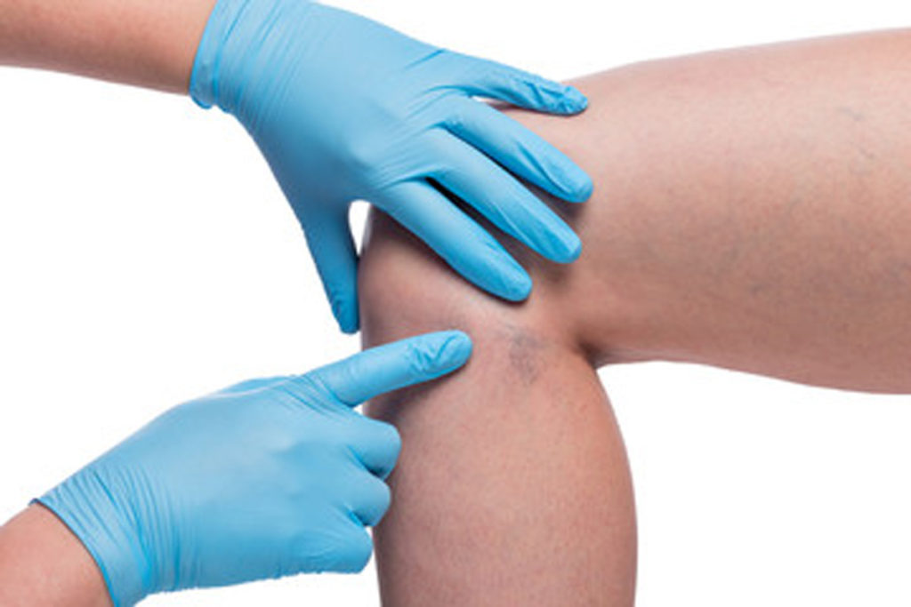 A doctor examining a patient’s leg before performing an El Paso vein treatment.