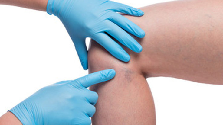 Which El Paso Vein Treatment Is Best for You