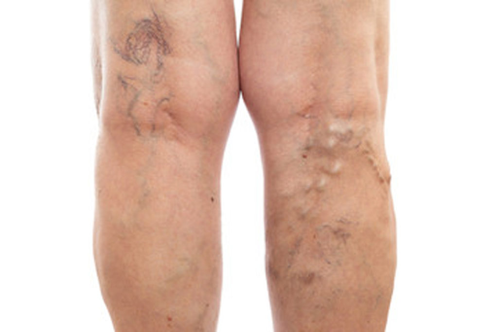 A woman’s legs with varicose veins.