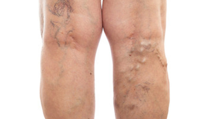 Varicose Veins – Causes and Treatment