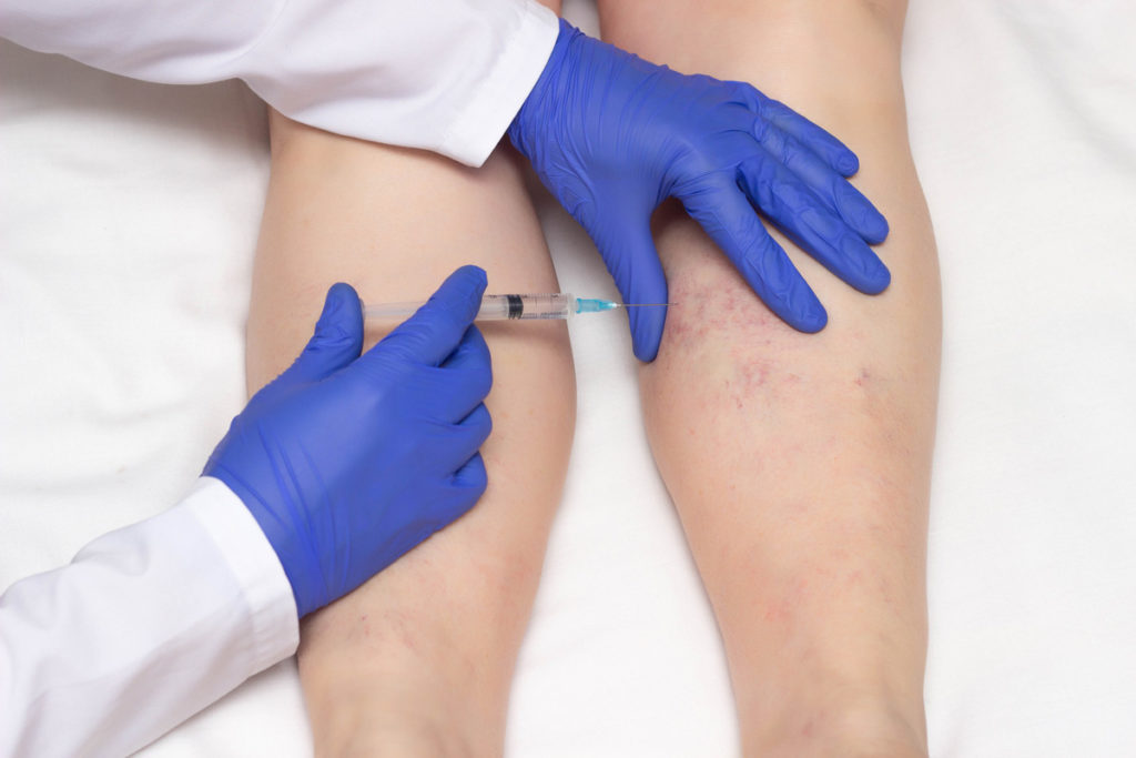 A vascular surgeon injecting a solution into a person’s legs during sclerotherapy in El Paso.