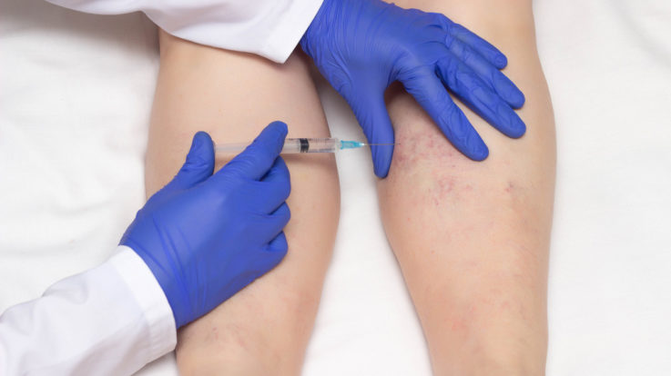 How Sclerotherapy Can Help Treat Spider Veins
