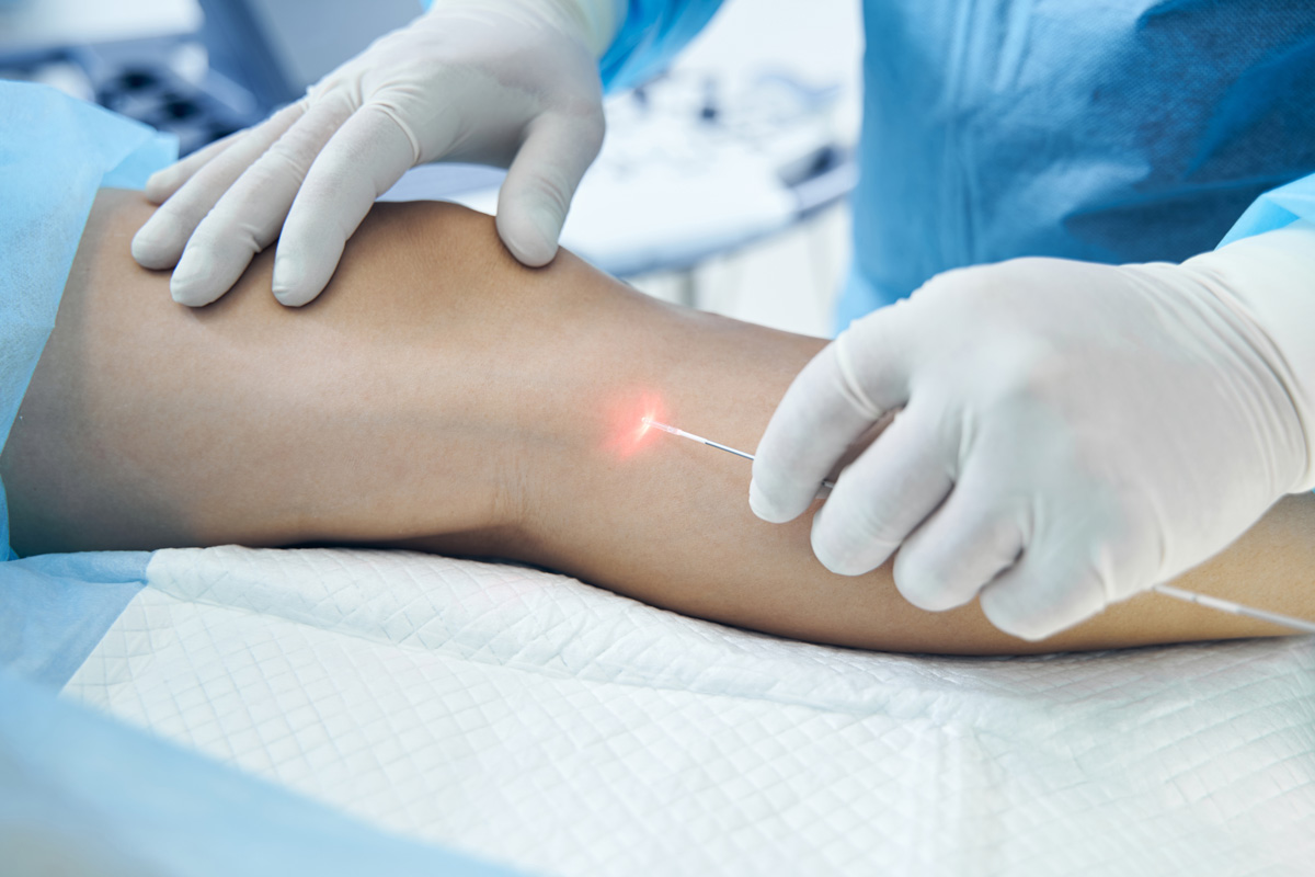 A vascular surgeon performing endovenous laser therapy on a patient’s leg in El Paso.