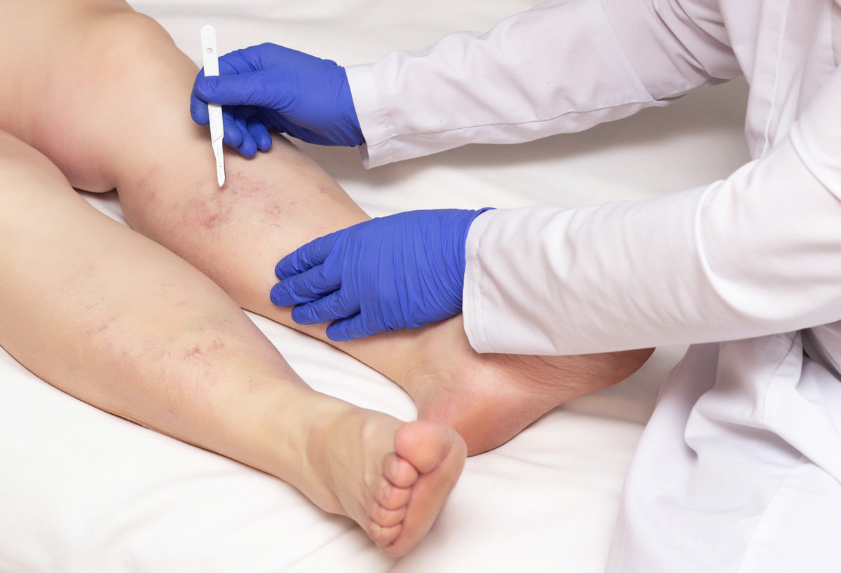 A person’s leg with varicose veins being examined by a doctor in El Paso.