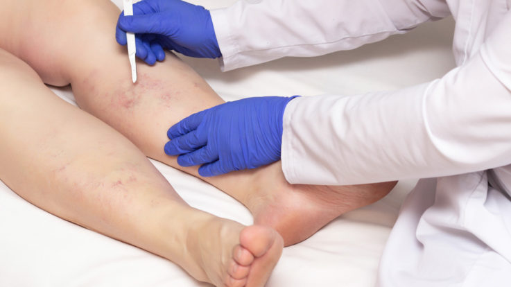 When to Seek Medical Intervention for Varicose Veins