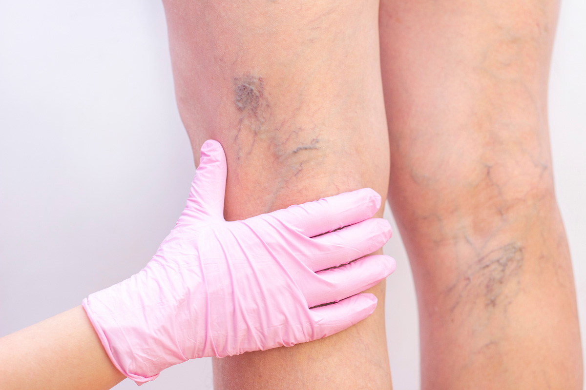 A person’s hand in a pink medical glove holding a person’s leg with varicose veins in El Paso.