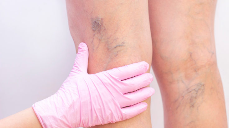 Beyond Cosmetic Concerns: The Importance of Vein Treatments