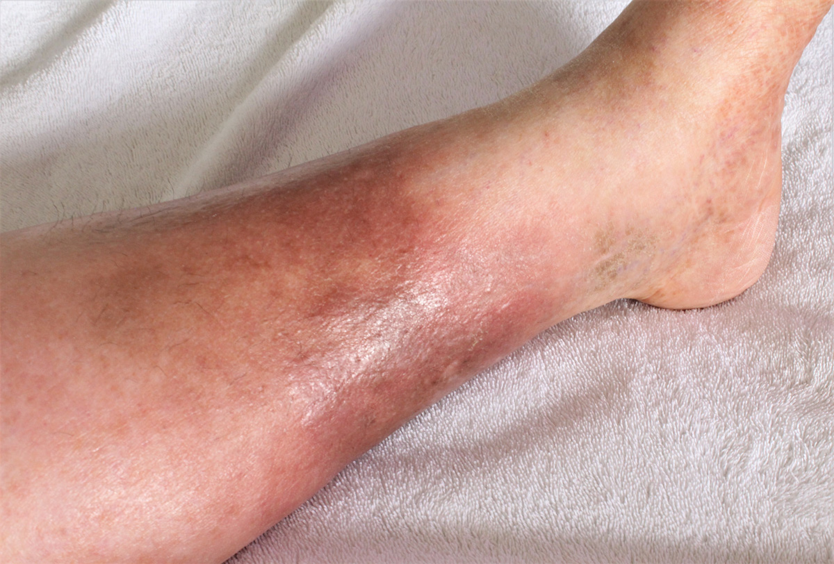 A person’s lower calf with DVT in El Paso.