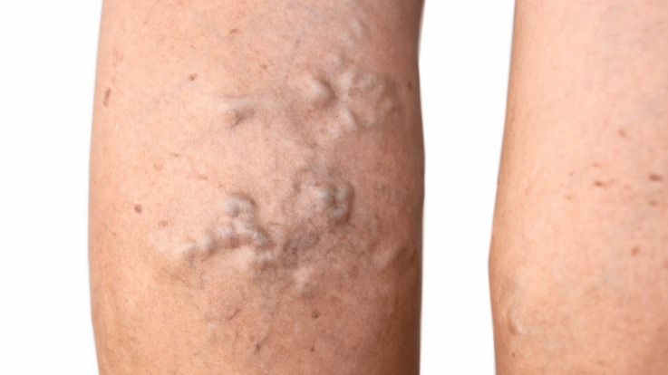 What Complications Can Untreated Varicose Veins Lead To?